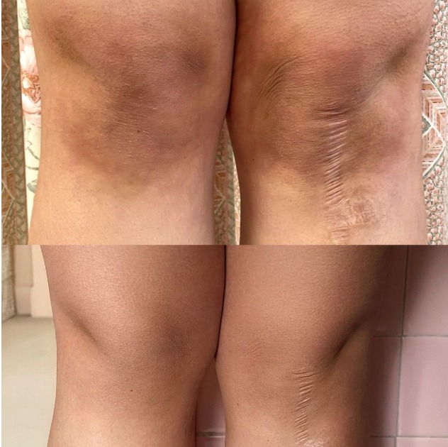 Resultado do tratamento Clarive